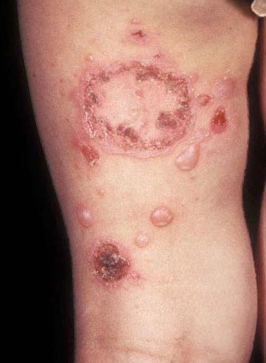 bacterial rash