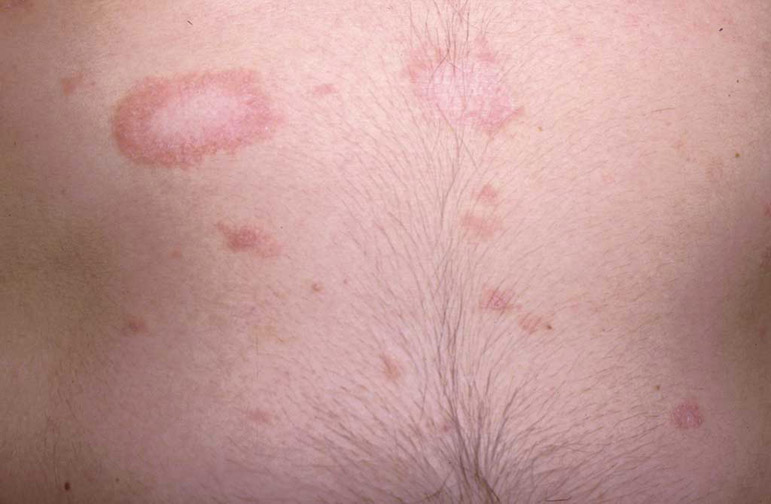 Common Skin Infections: Common Skin Infections