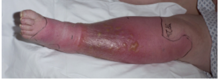 Junior casualty officers often refer 'bilateral cellulitis' when in fact the diagnosis is usually varicose eczema with venous hypertension, allergic contact ...