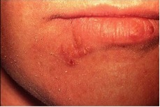 typical cold sore