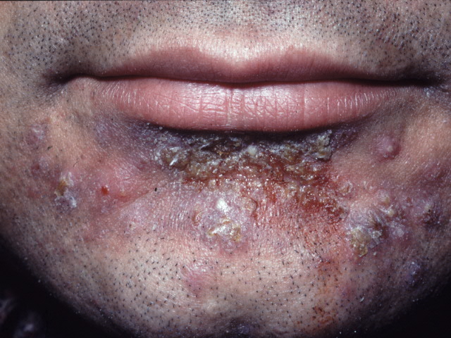 bullous impetigo in an adult