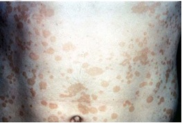 pityriasis versicolor