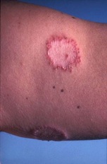 tinea corporis on the arm