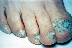 extensive tinea unguium toe nails