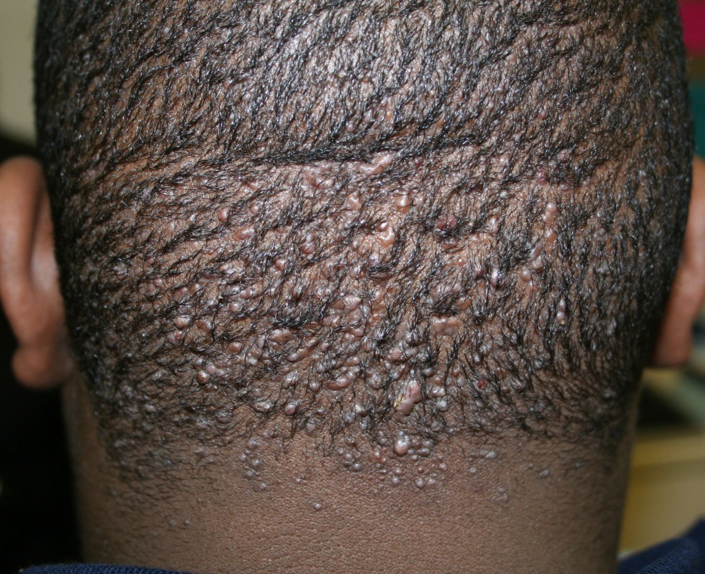 Folliculitis Scrotum